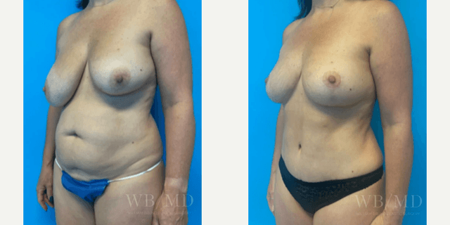 Mommy Makeover procedure image