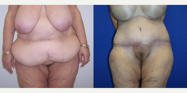 Liposuction procedure image