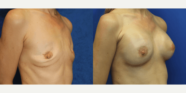 Breast Augmentation procedure image