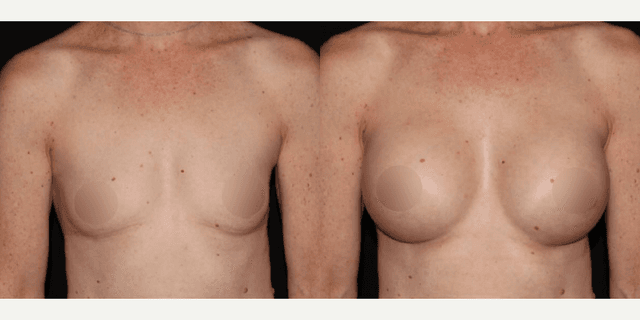 Breast Augmentation procedure image