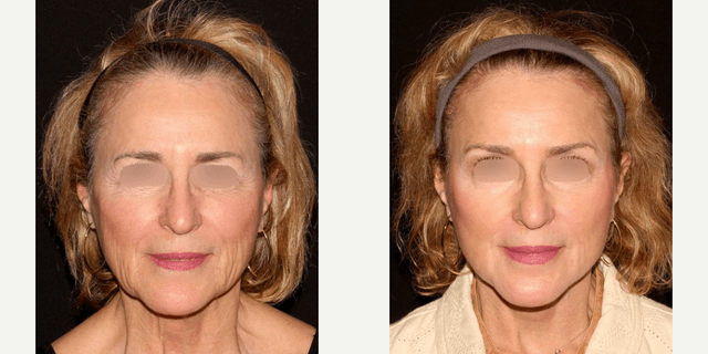 Facelift procedure image