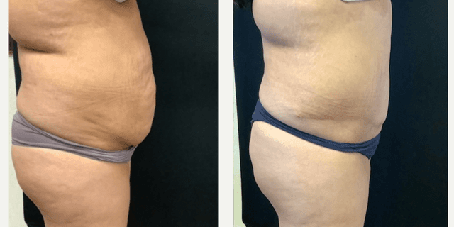 Liposuction procedure image