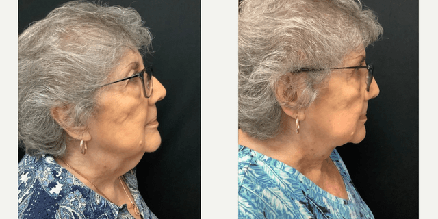 Neck Lift procedure image