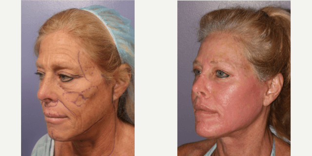 Neck Lift procedure image