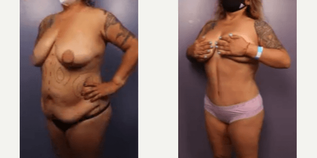 Liposuction procedure image