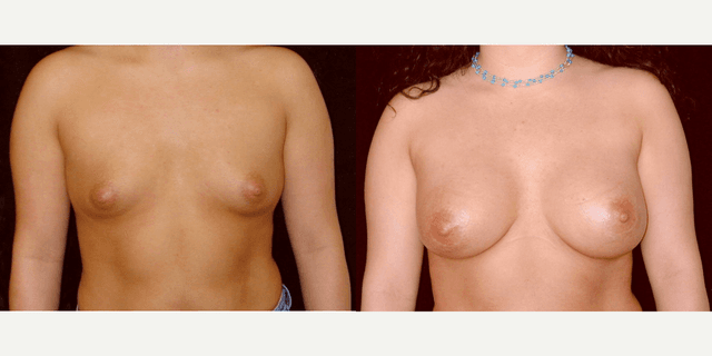 Liposuction procedure image