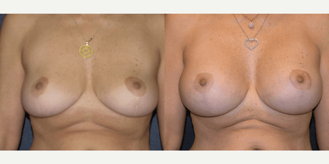 Breast Lift (Mastopexy) procedure image