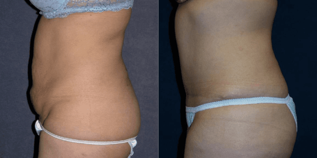 Tummy Tuck (Abdominoplasty) procedure image