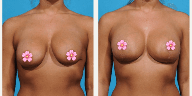 Breast Lift (Mastopexy) procedure image