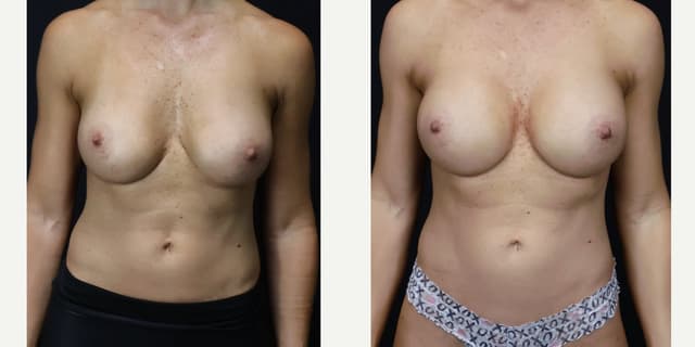 Breast Implants (Saline/Silicone) procedure image