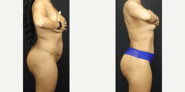 Tummy Tuck (Abdominoplasty) procedure image