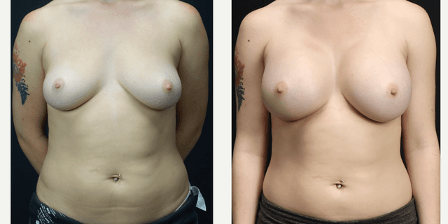 Breast Augmentation procedure image