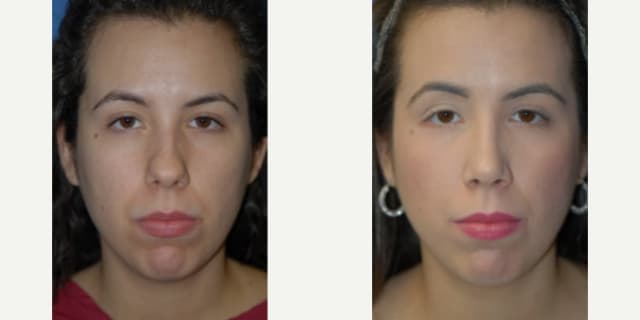 Facelift procedure image