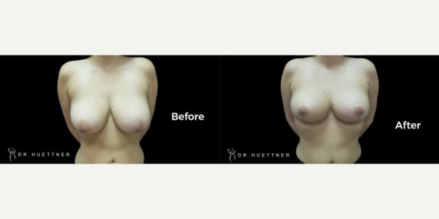 Breast Lift (Mastopexy) procedure image