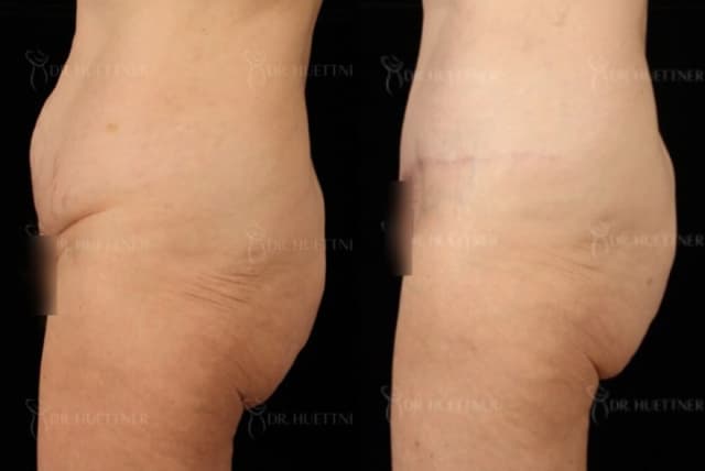 Skin Tightening procedure image