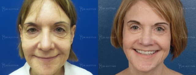 Facelift procedure image