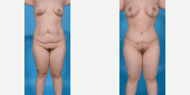Breast Lift (Mastopexy) procedure image