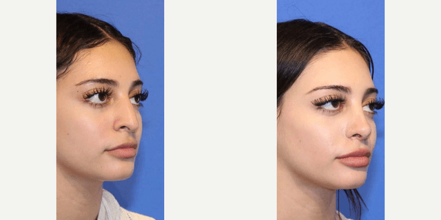 Rhinoplasty (Nose Job) procedure image