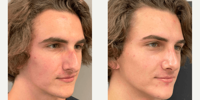 Rhinoplasty (Nose Job) procedure image