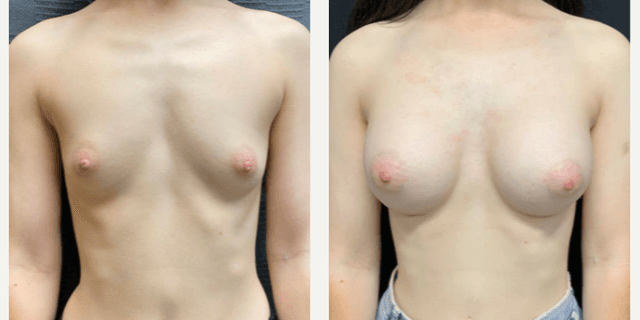 Breast Augmentation procedure image