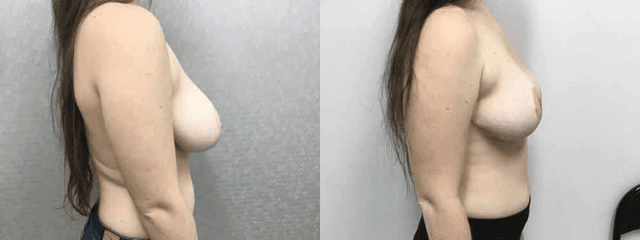 Breast Lift (Mastopexy) procedure image