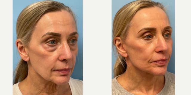 Eyelid Surgery (Blepharoplasty) procedure image