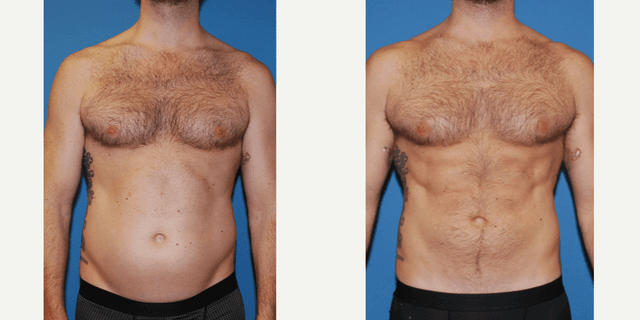 Body Lift procedure image