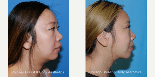 Skin Rejuvenation & Resurfacing procedure image