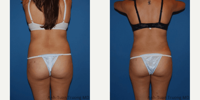Breast Augmentation procedure image