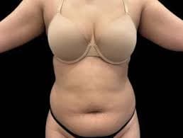 Mommy Makeover procedure image