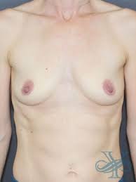 Breast Augmentation procedure image