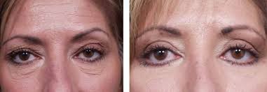 Eyelid Surgery (Blepharoplasty) procedure image