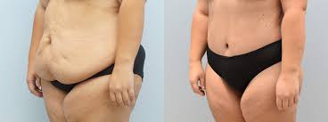 Body Lift procedure image