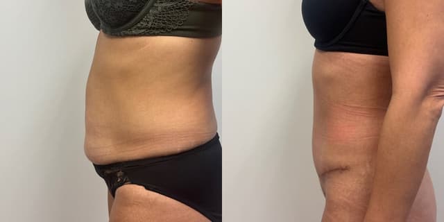 Tummy Tuck (Abdominoplasty) procedure image