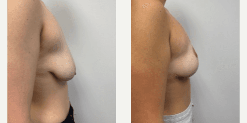 Breast Lift (Mastopexy) procedure image
