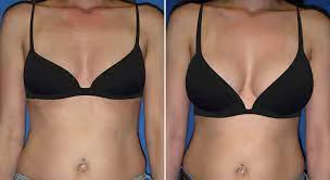 Liposuction procedure before